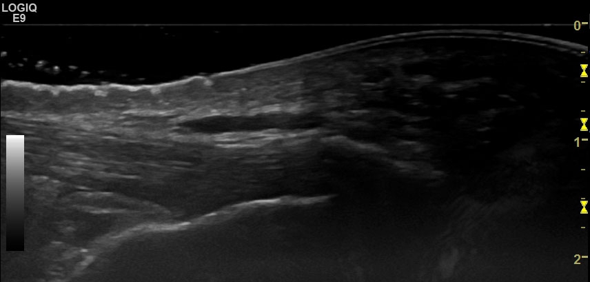 Subcutaneous on sale calcaneal bursitis